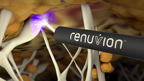 renuvion-heating-1